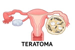 teratoma